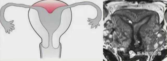 子宫发育异常,应想到的6大类常见畸形