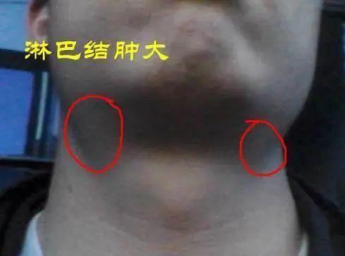 25岁女学生感冒不好，检查结果出来，5个男孩慌忙赶到医院