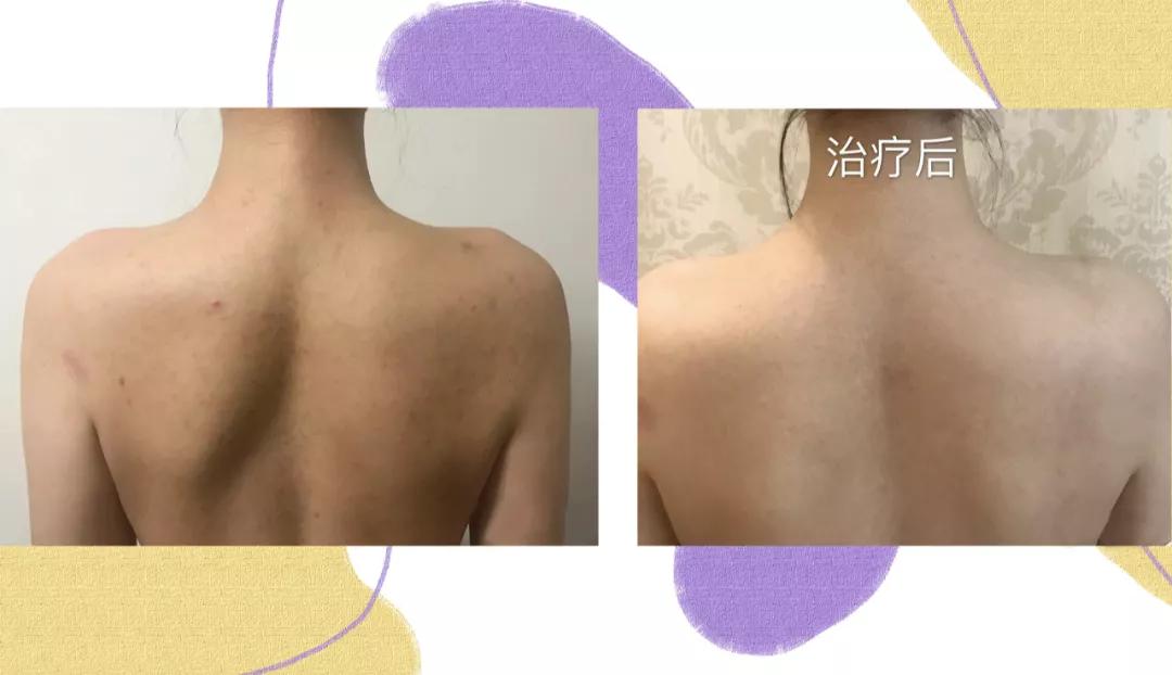 医美做什么能永远不长痘,脸很多痘坑做什么医美