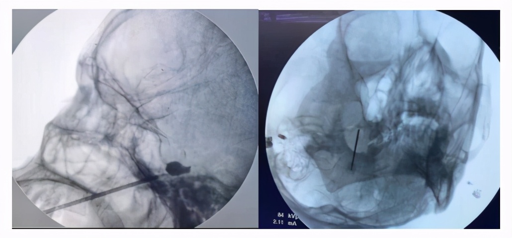 赶走疼痛，一身轻松！腰背痛，太原市中心医院疼痛科有妙招