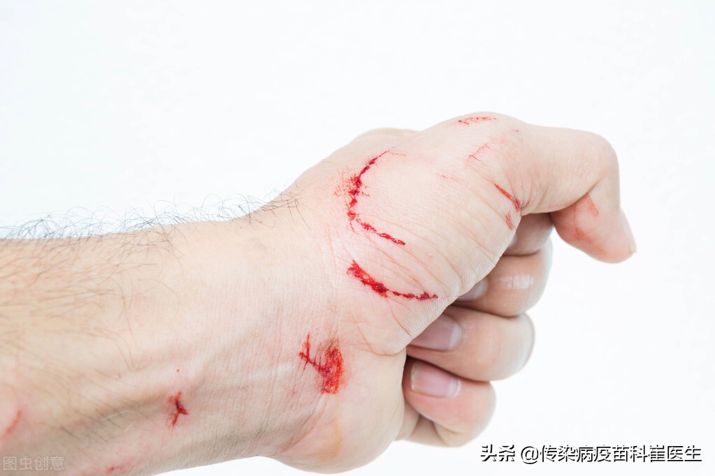 刚打了新冠疫苗被猫猫抓伤,刚打完新冠疫苗被猫抓了怎么办