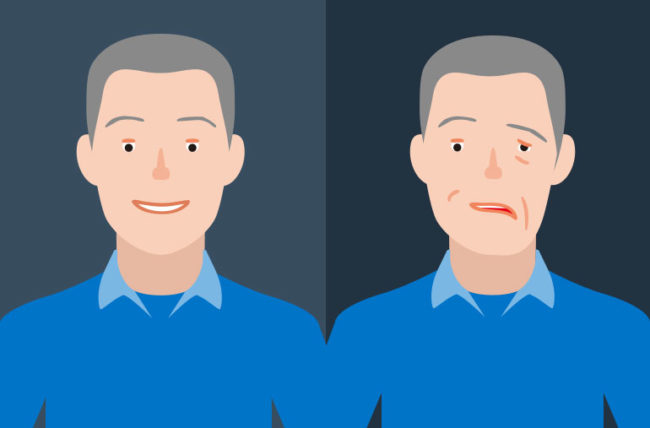 面瘫嘴歪了属于什么病,嘴巴歪是面瘫还是中风