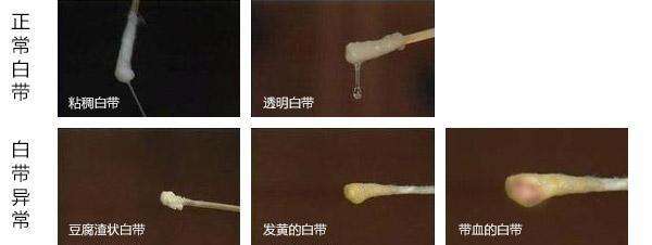 小腹疼痛白带异常,妇科炎症白带异常
