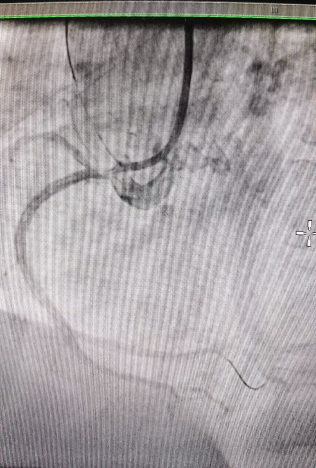 信阳市中心医院心脏射频消融手术,信阳中心医院心血管科室怎样