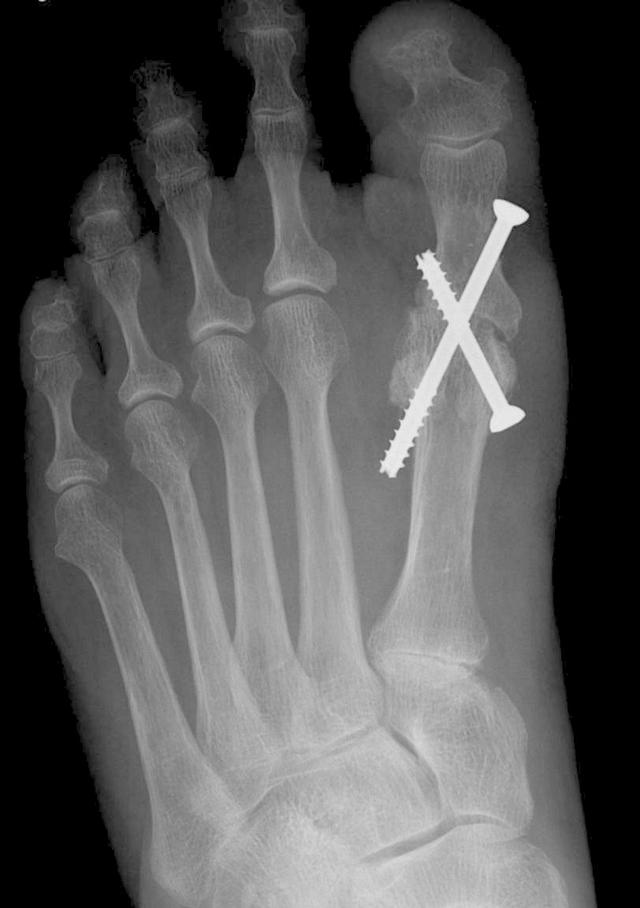 拇外翻大脚趾疼如何在家就能治,大脚拇指痛要警惕