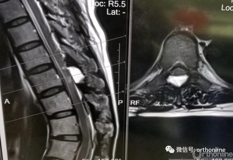 胸椎怎么做微创,脊柱内镜微创操作流程