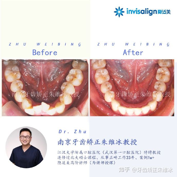 南京牙齿矫正骨性嘴凸案例,郑州牙齿矫正会让脸型更好看吗