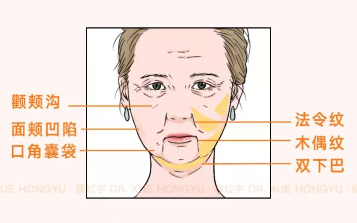 面部吸脂可以瘦脸,面部吸脂全脸什么部位不能吸
