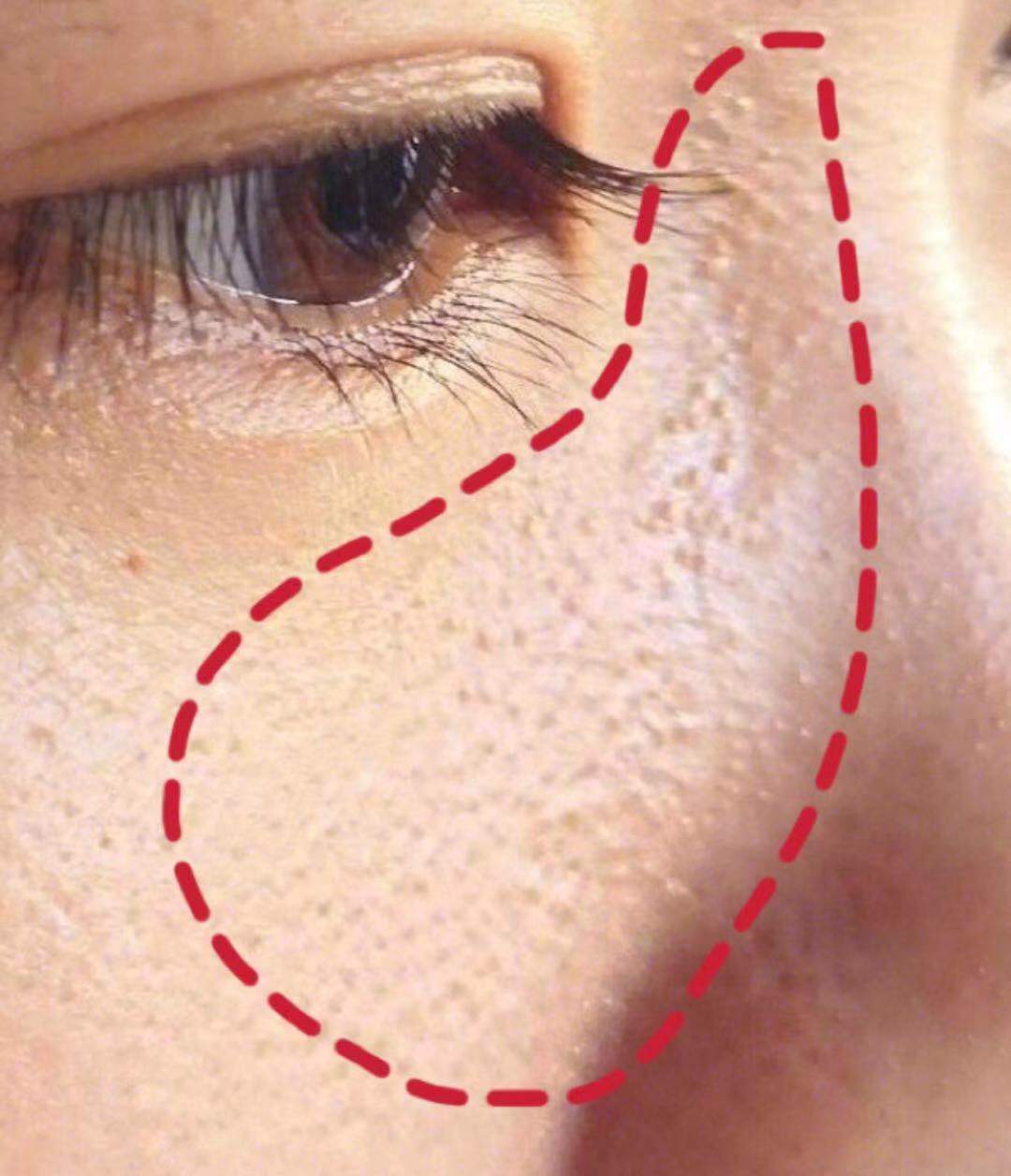 脸上有个光滑不痛不痒的小疙瘩,脸上皮肤粗糙长疙瘩是怎么回事