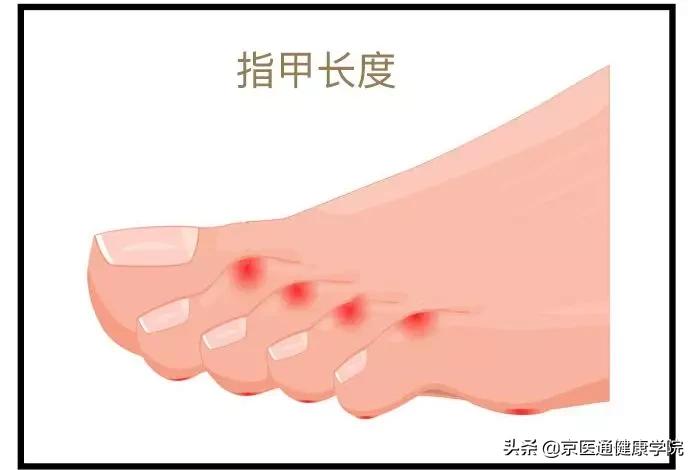 糖尿病最怕「糖尿病足」的出现或加重，专家教你6招巧预防