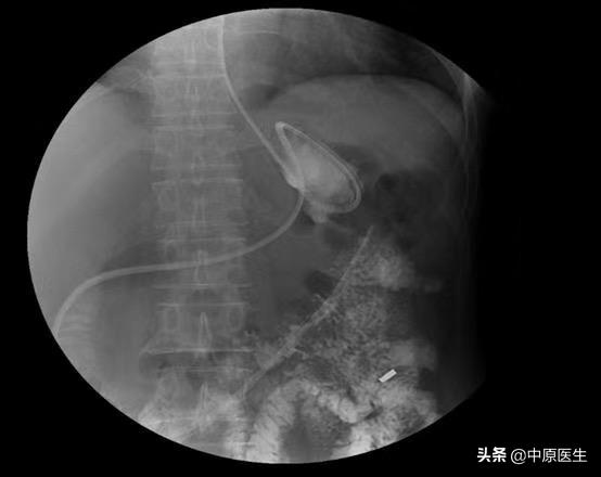 女子用洁厕灵中毒,因抑郁症误服洁厕灵算工伤吗