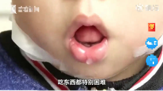 5岁男童张嘴睡觉用嘴呼吸正常吗,小孩反复张嘴闭嘴