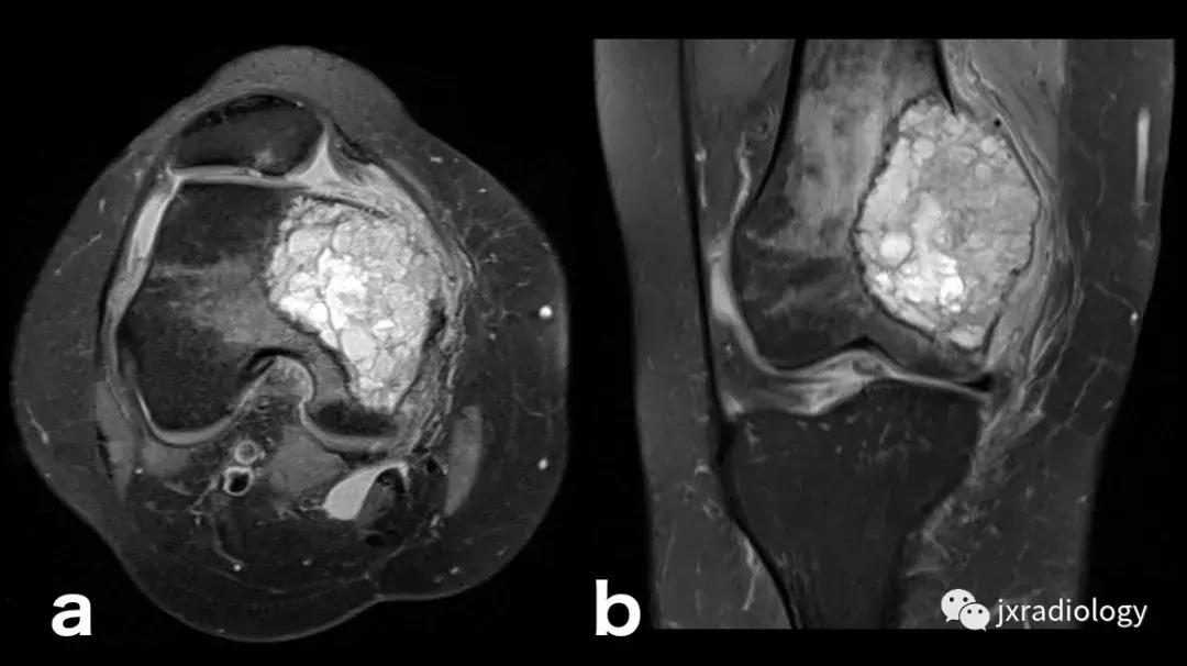 磁共振天天诊断骨髓水肿，但您知道原因吗？