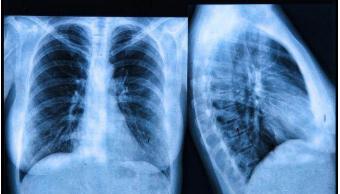 国外肺癌靶向药有哪些,印度第四代肺癌靶向药