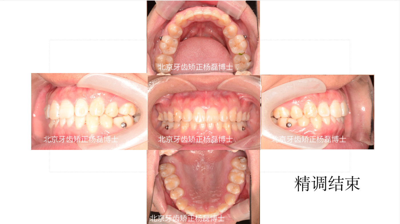 正畸医生杨磊,北大口腔医院修复科杨磊