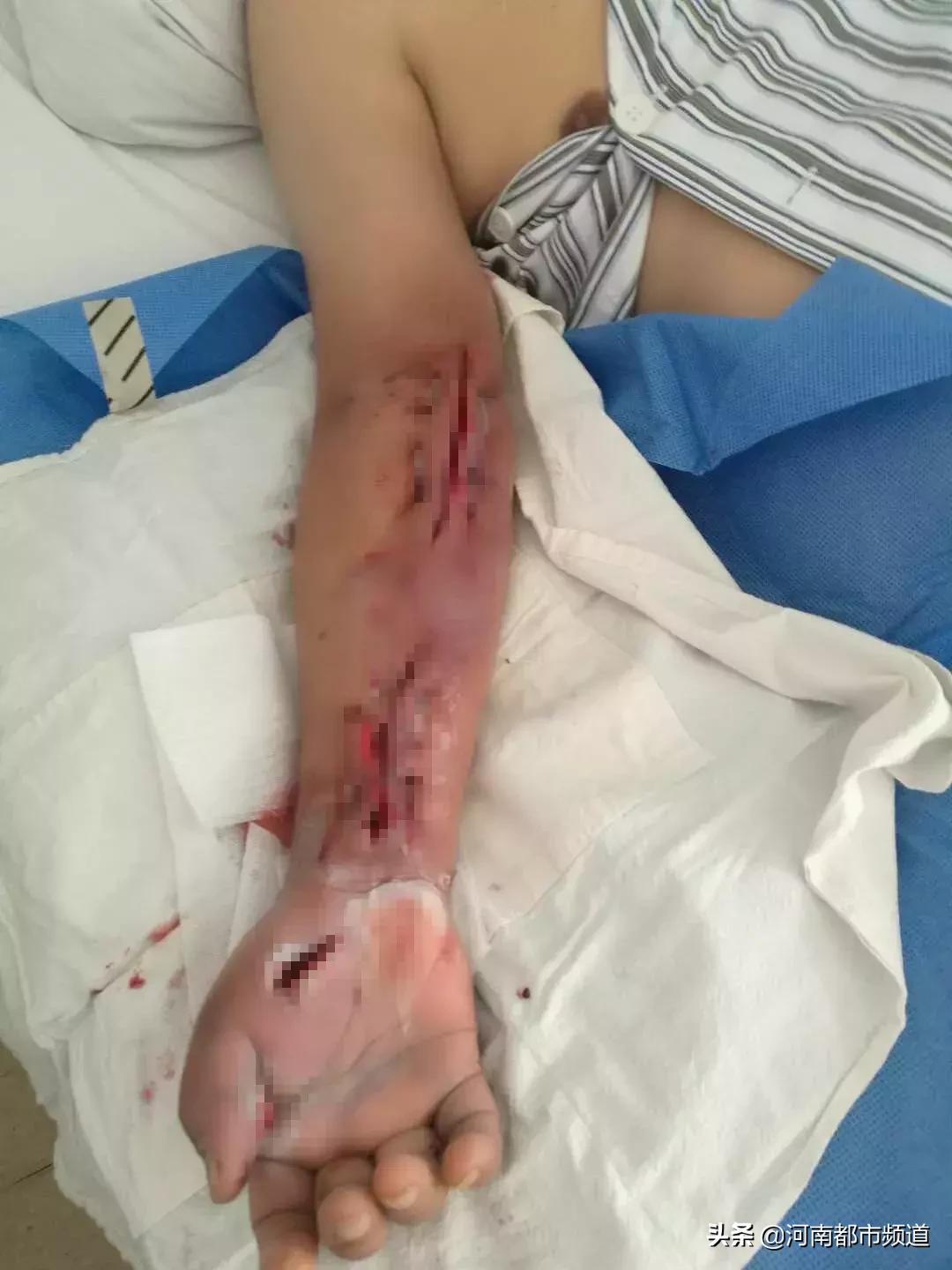 男子被虾刺刺伤伤残能赔付吗,一男子被虾刺身亡