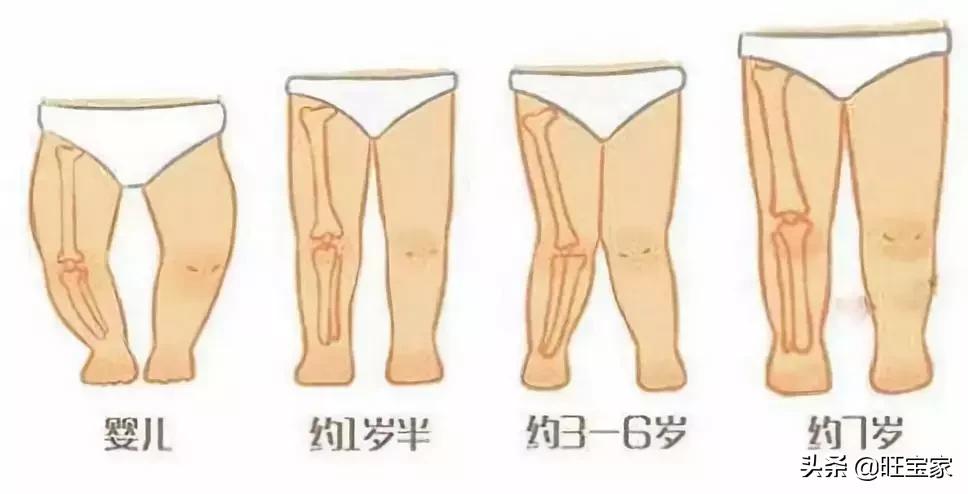 林允儿天使照,林允儿o型腿怎么变直的