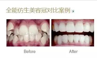 美容冠是指的什么,美容冠到底是什么