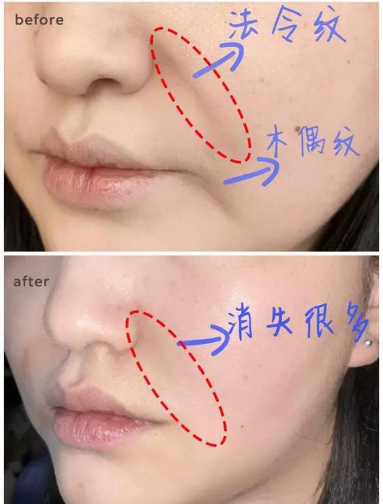 硬刚女皇龙妈也扛不住法令纹，2条沟壑让人心疼，贴一贴就消了