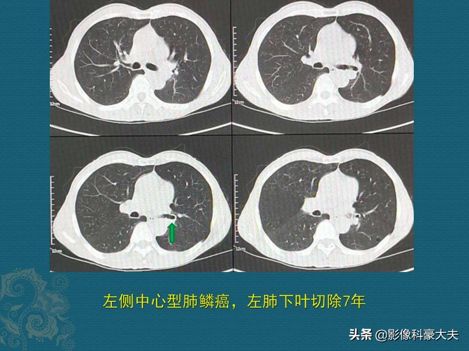 这5种癌一发现就是晚期,第一例癌症患者治愈