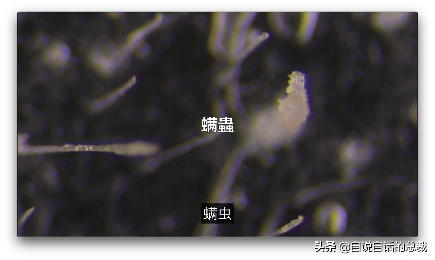 毛囊异型,毛囊里的异形物