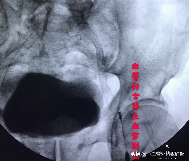外周血管外科治疗范围,外周血管介入治疗疗程