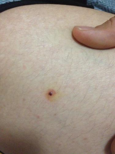 身上有针尖大小黑点,身上出现不明黑点