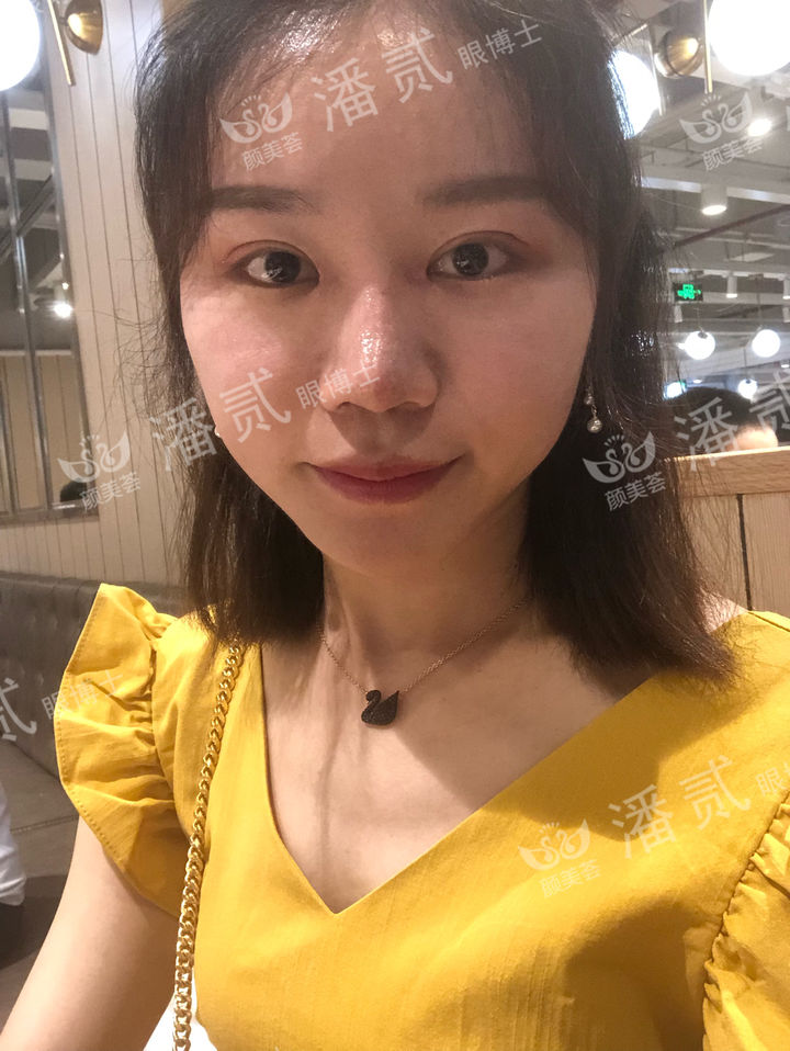 开眼角过大图片,开眼角过大修复效果图