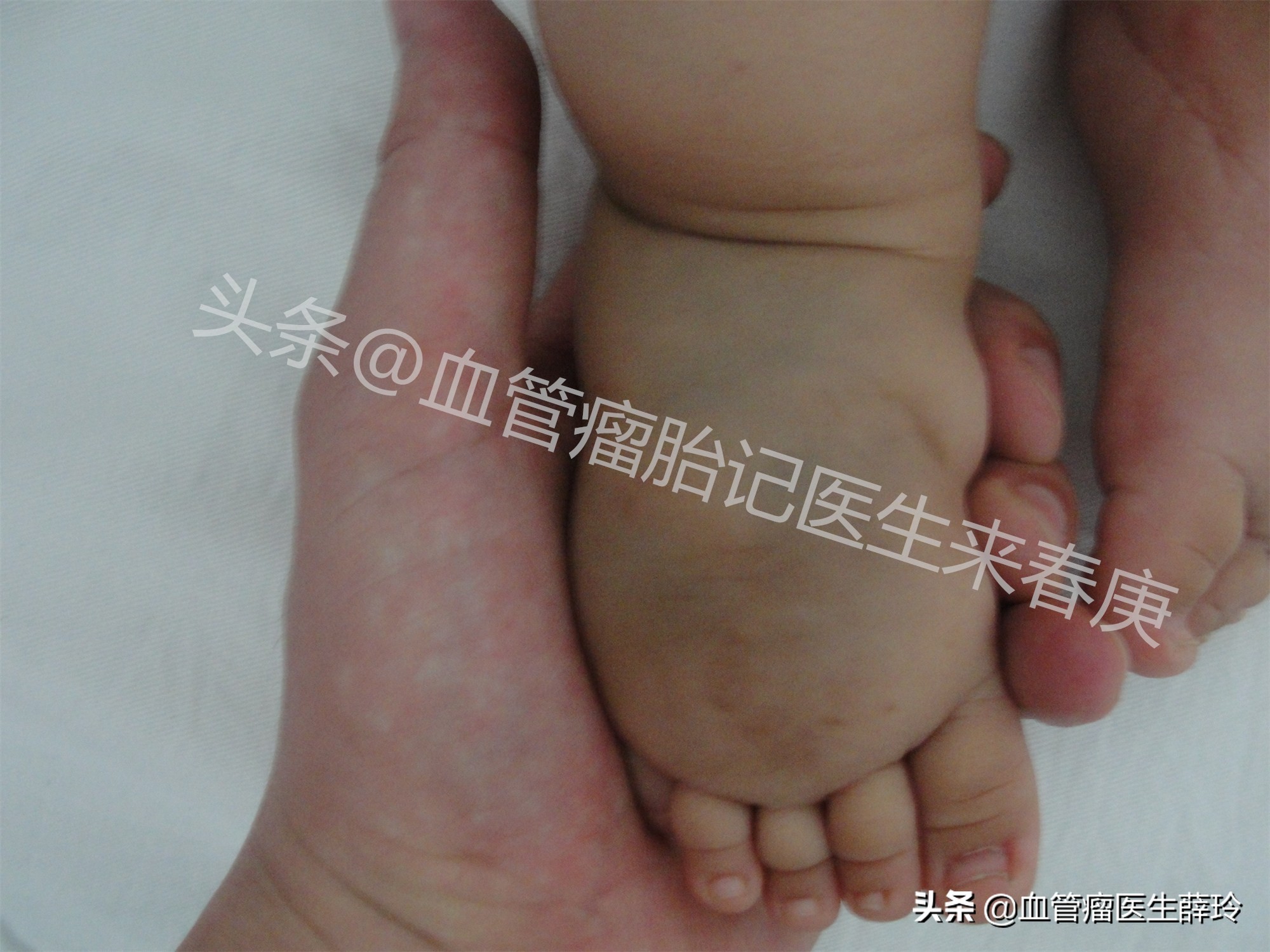 小脑海绵状血管瘤有什么危害吗,脑内海绵状血管瘤最好的治疗方法