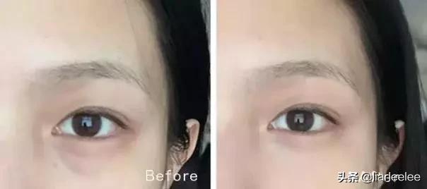 防眼角皱纹最好的方法,眼部皱纹多特别显老