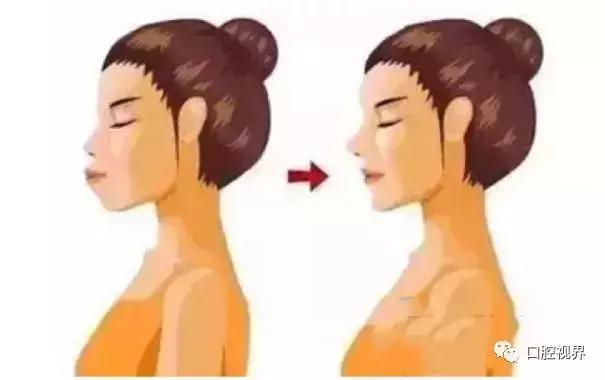 凸嘴龅牙如何变身美人,轻微龅牙如何整形