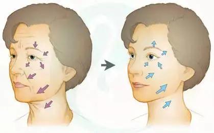 面部抗衰除皱仪器,抗衰除皱术是什么
