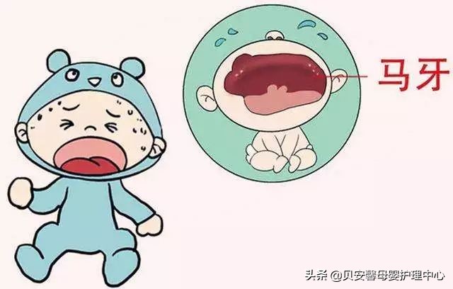 马牙和鹅口疮会同时出现吗,婴儿马牙与鹅口疮鉴别