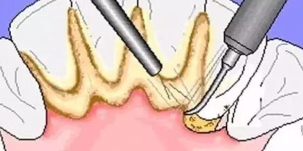 牙神经痛警惕四种病,警惕7大危害牙齿的坏习惯