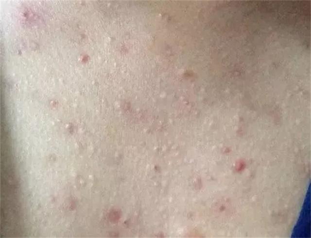 祛痘痘后背好物推荐,祛除背部痘痘好物推荐