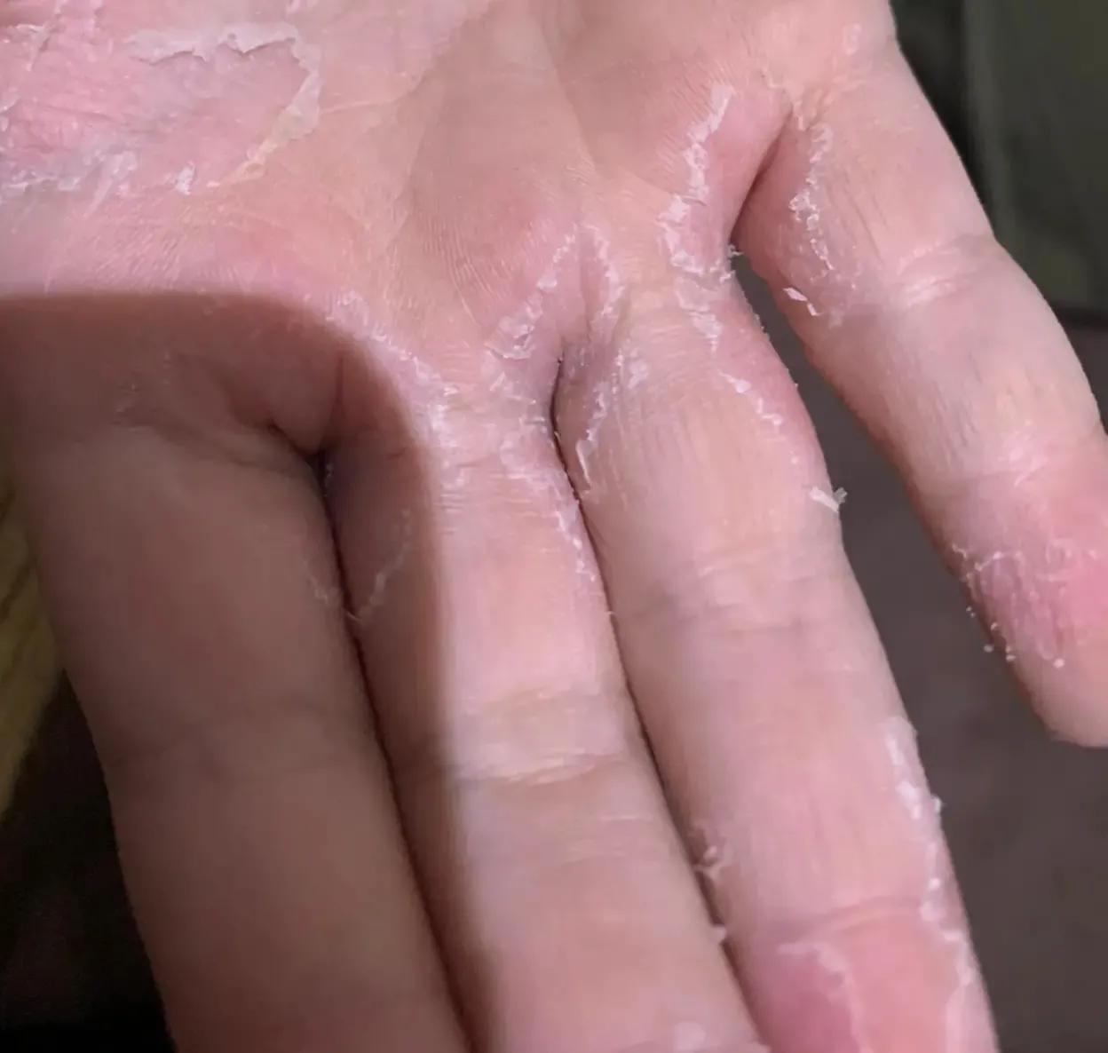 孩子手指脱皮不痒是怎么回事,手指脱皮儿童可用艾草水泡吗