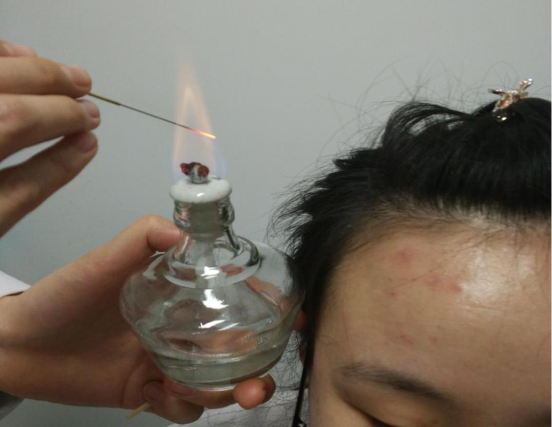 火针治疗暗疮,火针治疗痤疮留红色印子