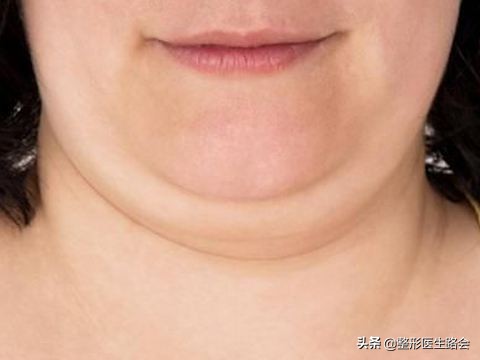 去除双下巴和颈部脂肪手术,手术去除下巴赘肉最有效的方法