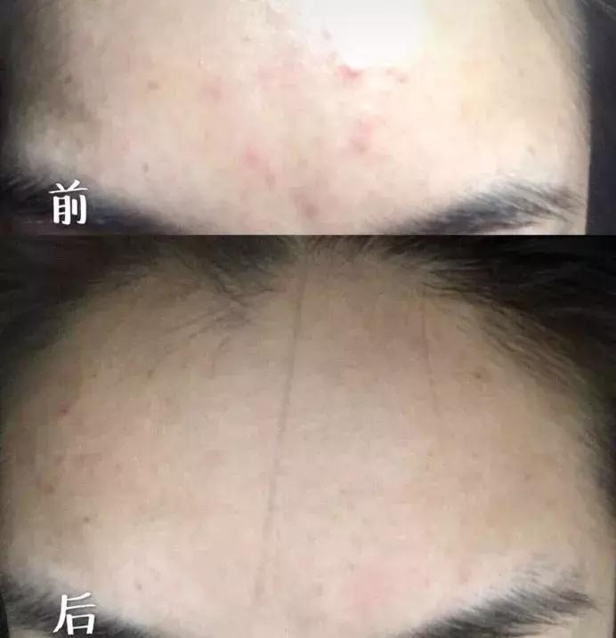 烟酰胺玻尿酸水光焕颜片美白效果,烟酰胺玻尿酸精华液美白淡斑霜