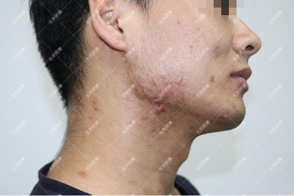 疤康治疗疼吗,疤康医院大疤痕可以治疗吗