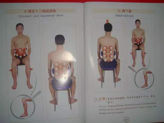 拔罐有哪些穴位图解,最全拔罐穴位疗法图解