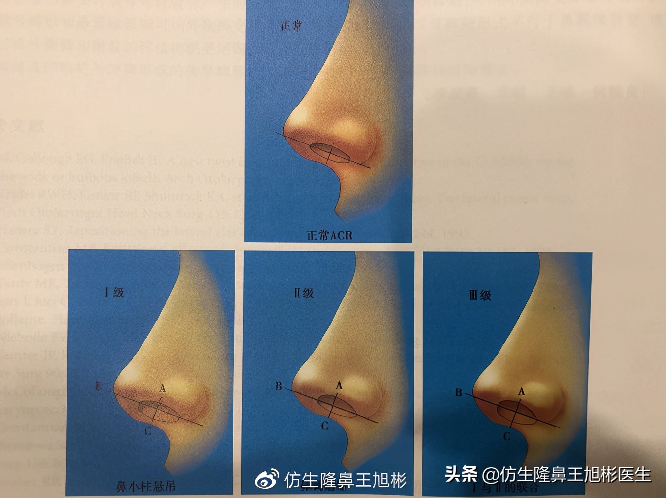 鼻翼缘退缩要如何矫正|王旭彬隆鼻