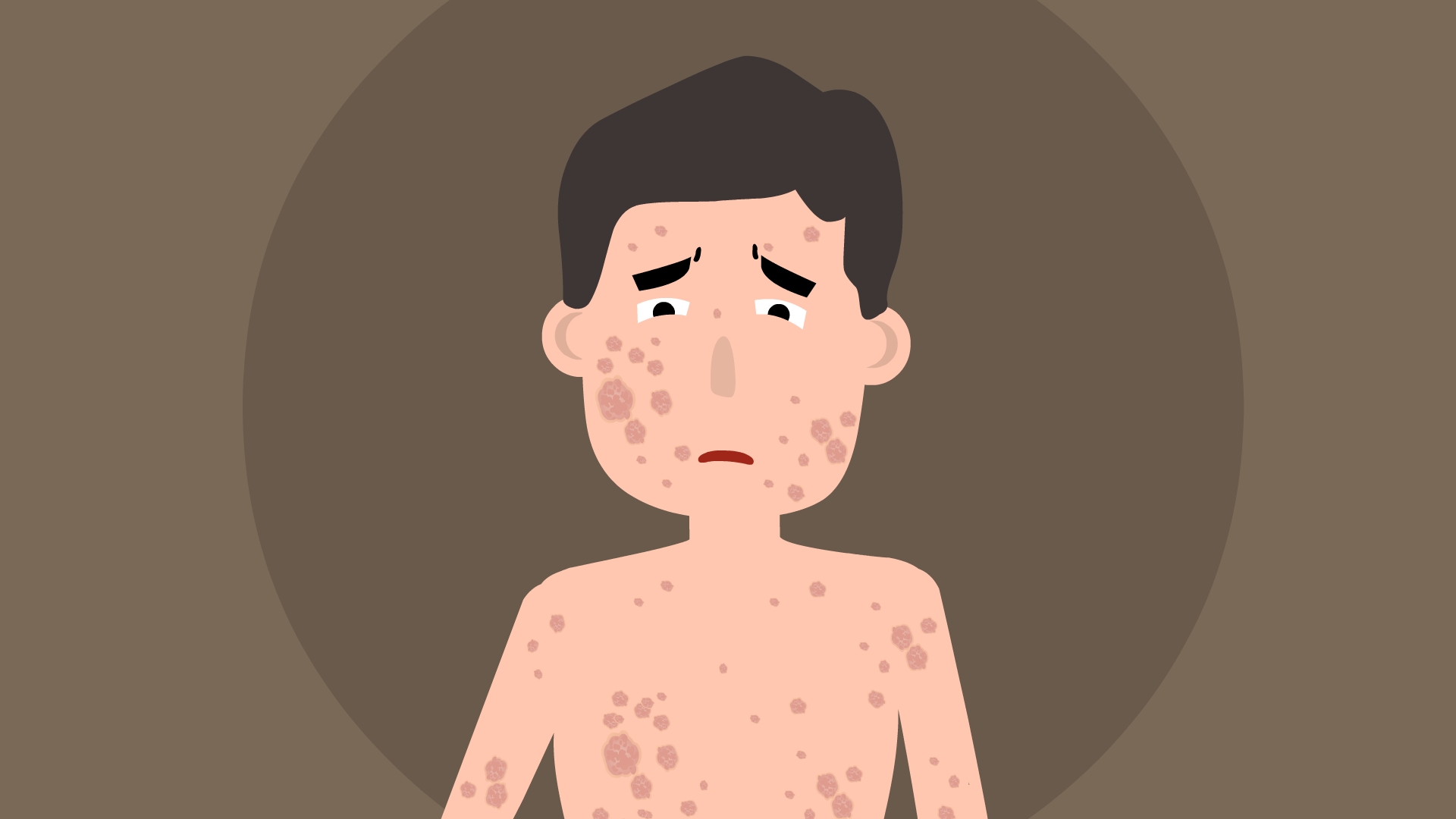 孢子丝菌病是皮肤病吗,孢子丝菌病是真菌吗