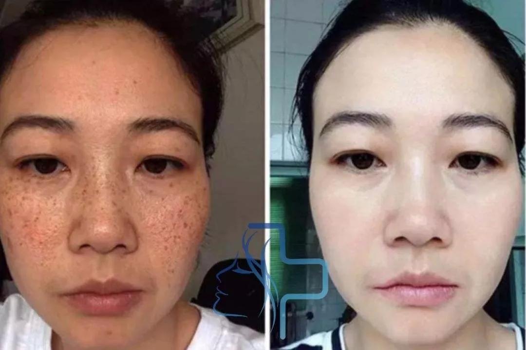 美白祛黄提亮肤色泡水喝,每天喝一杯可以美白淡斑清热解毒