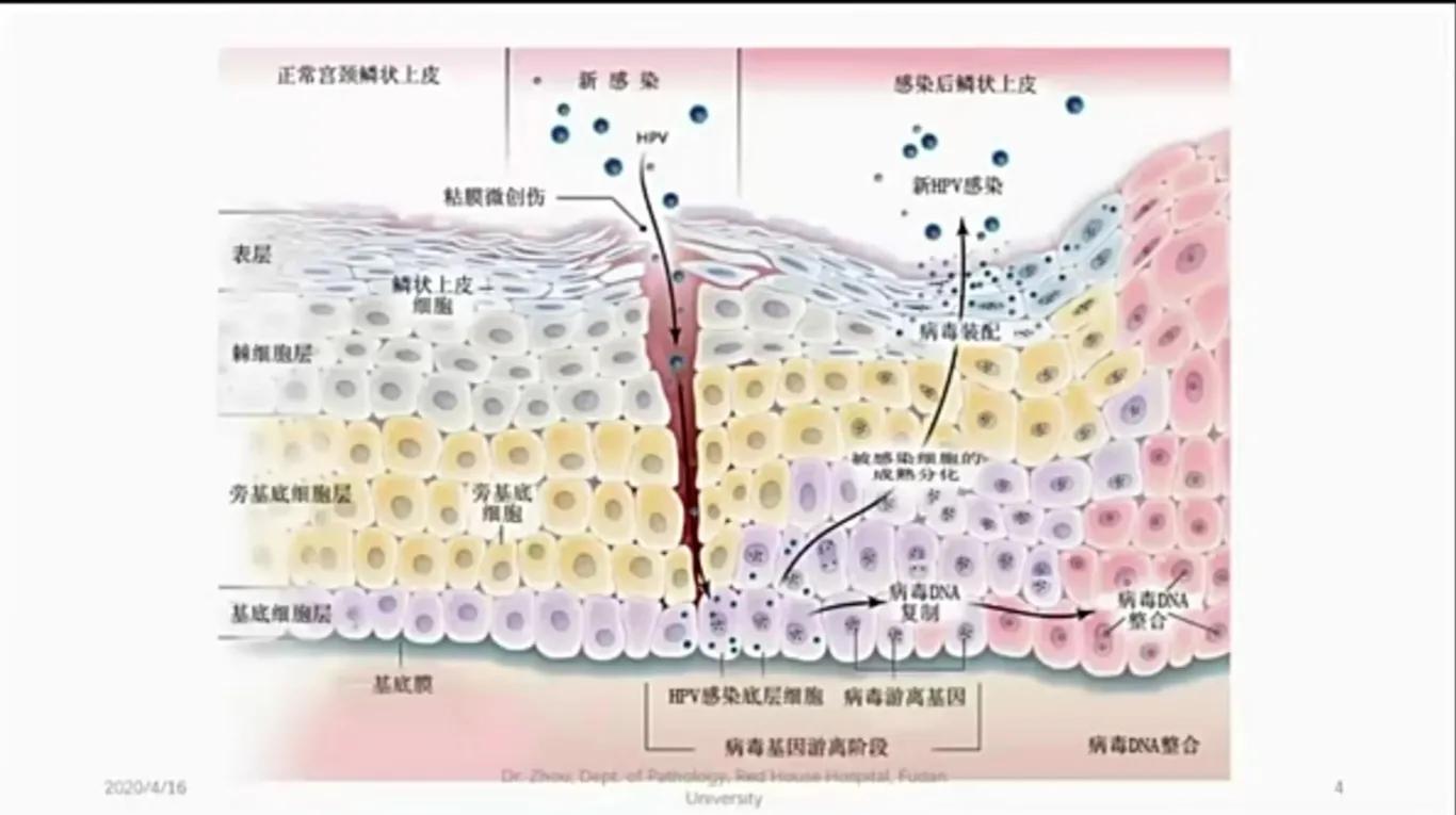 宫颈高级版鳞状上皮内病变指南,宫颈lsil低级别鳞状上皮内病变