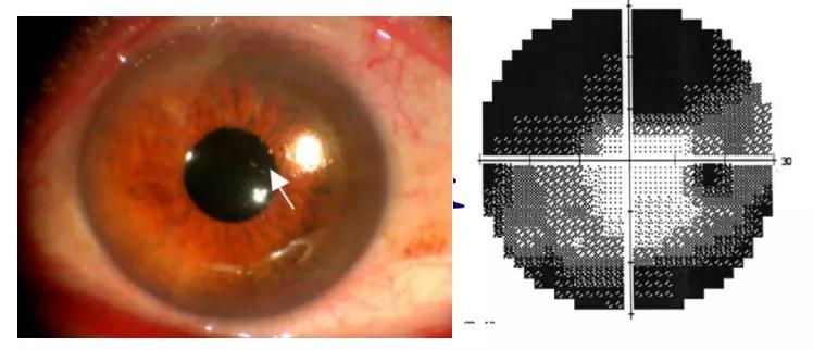 孙兴怀青睫综合症,孙兴怀谈ucp治疗青光眼