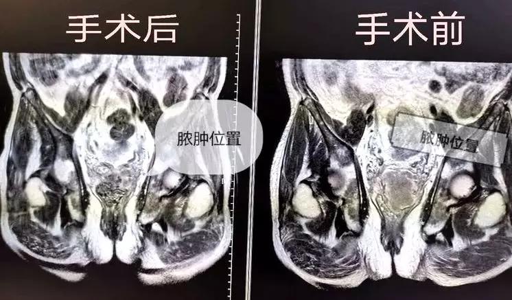 广州市八医院重症患者,多科协作成功抢救宫外孕患者