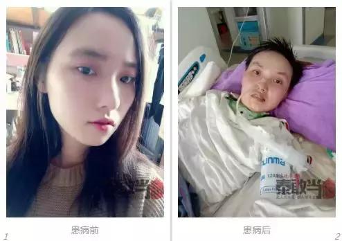 21岁女孩被蚊子咬进icu,20岁女孩被蚊子咬了一口