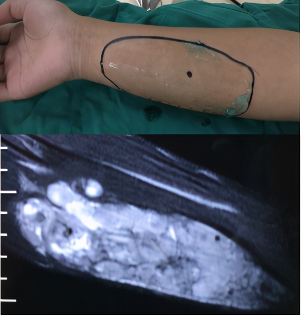 什么样的血管畸形不能打硬化剂,儿童血管畸形硬化过程