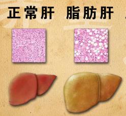 喝茶治脂肪肝吗,喝茶治疗脂肪肝吗